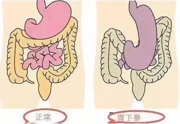 胃下垂吃什么中成药